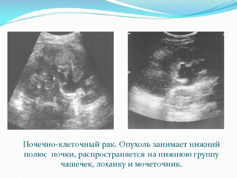 Почечно-клеточный рак. Опухоль занимает нижний полюс  почки, распространяется на нижнюю группу чашечек, лоханку